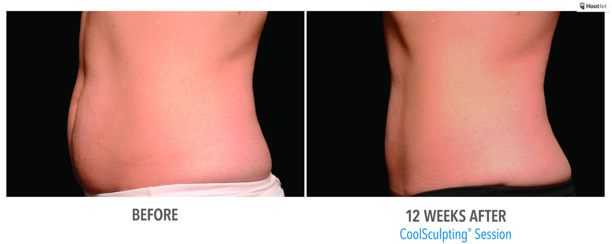Where Does the Fat Go After CoolSculpting & is it Worth the Price
