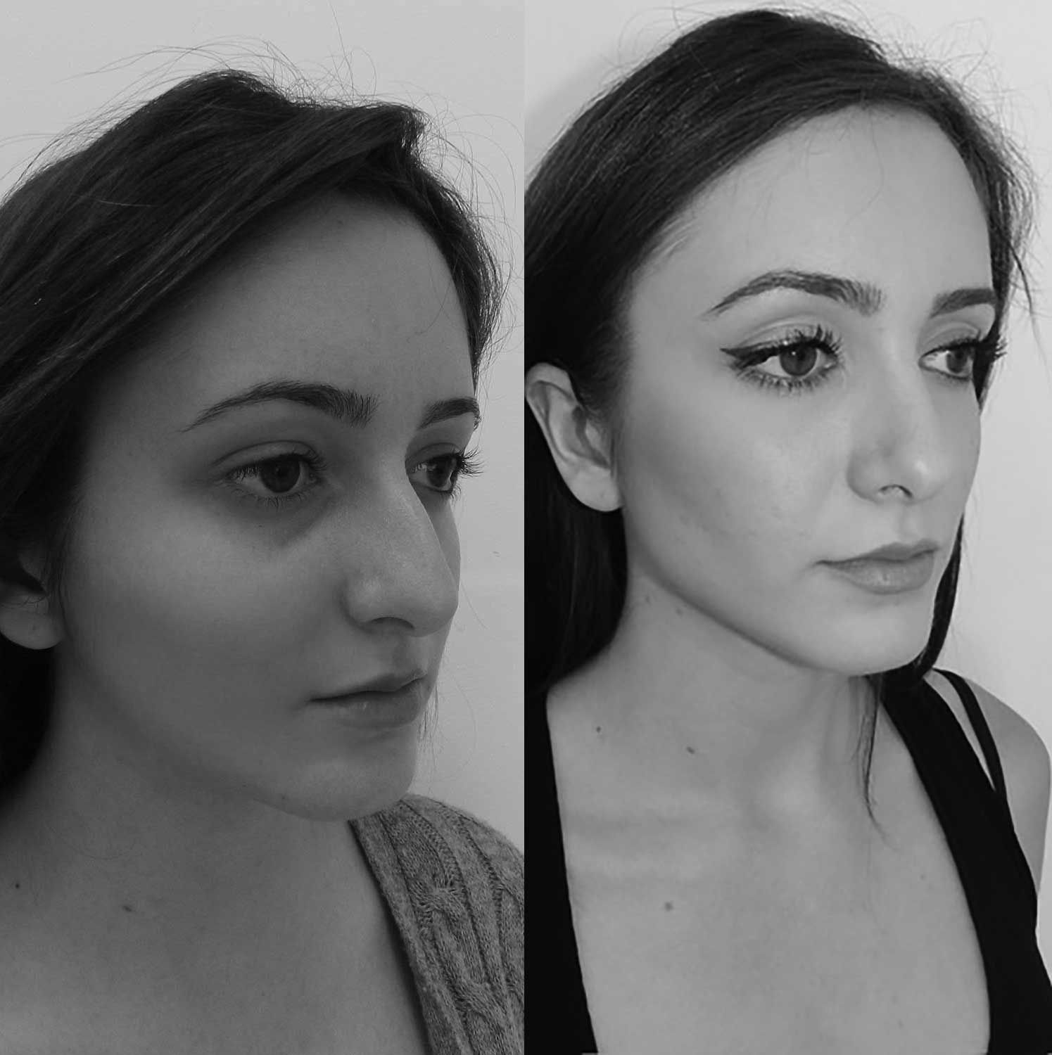 Facelift