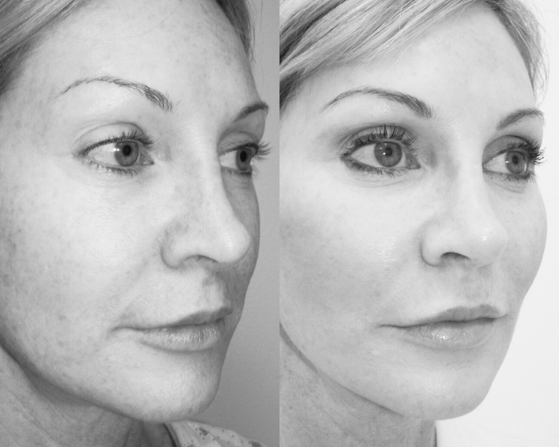 Facelift